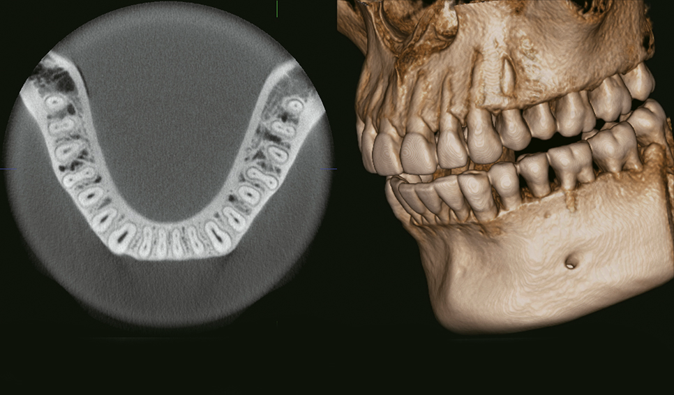 TAC dental en valls radiología